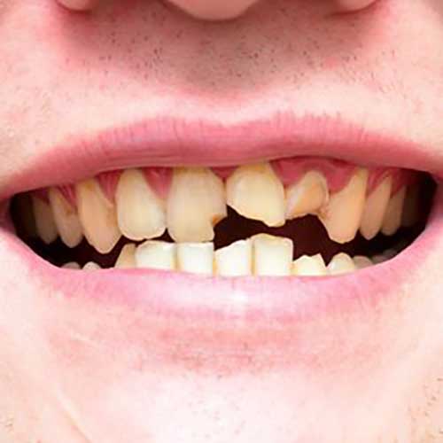 Chipped teeth