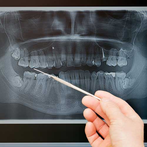 Dental x-ray