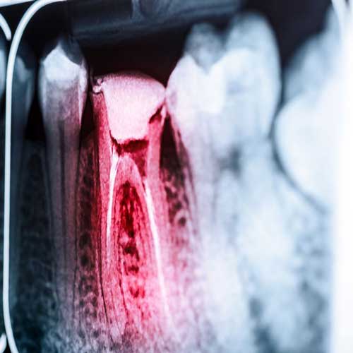 Infected root canal