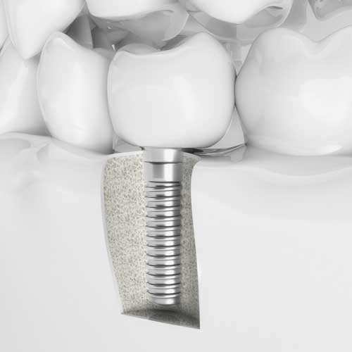 Dental implant