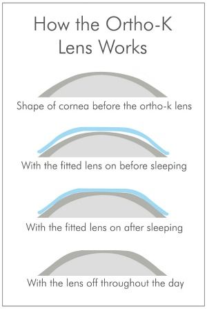 how ortho-k works