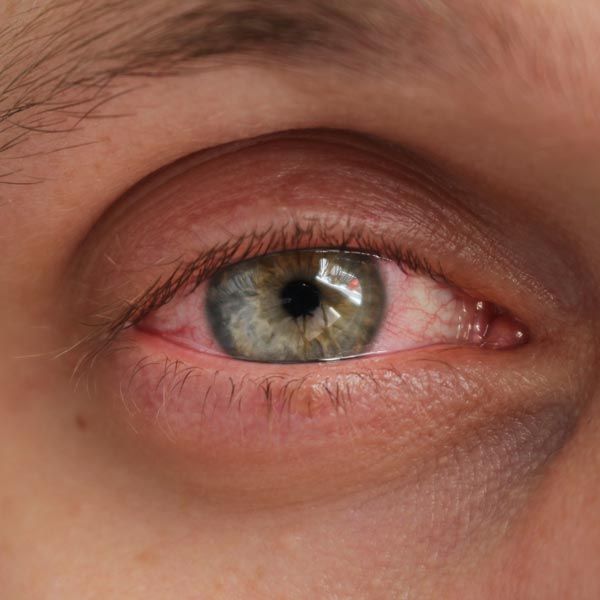 Close up of man's red eye