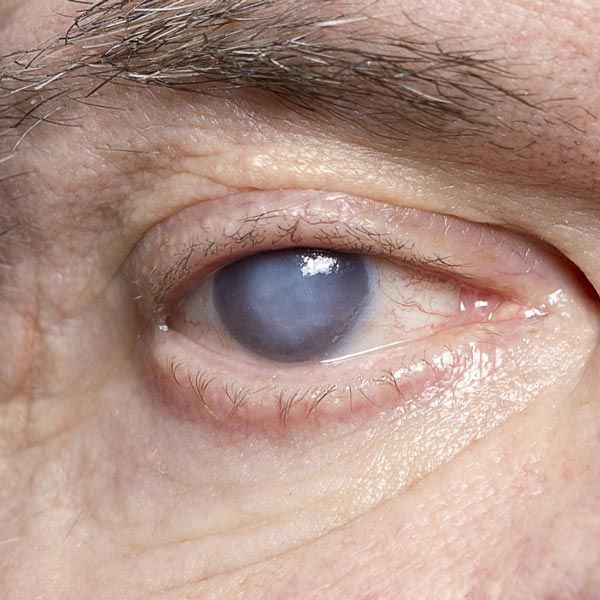 cataracts