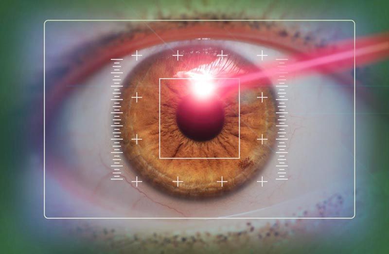 LASIK surgery