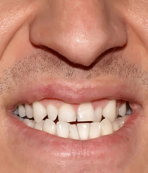 crooked teeth