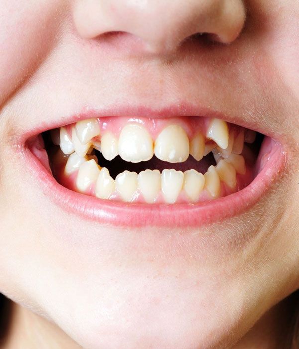 Overlapping Teeth