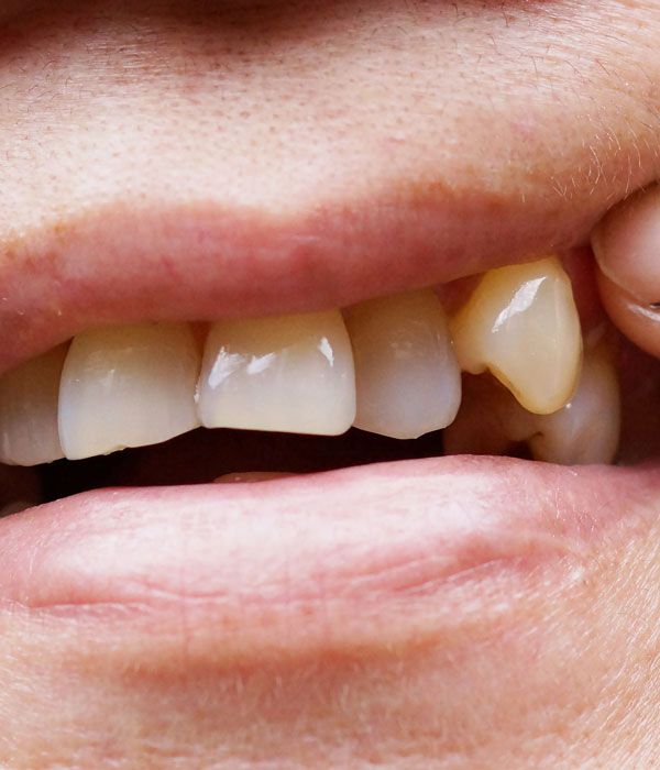 A Twisted or Turned Tooth