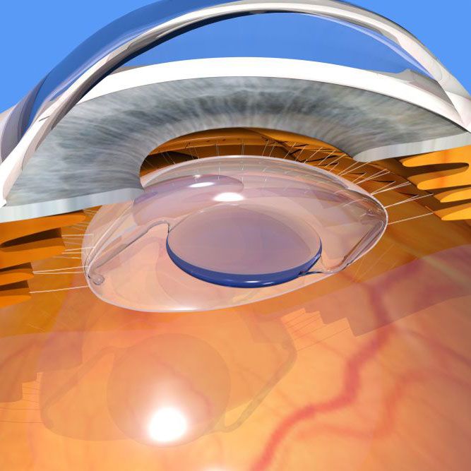 an illustration of cataract surgery
