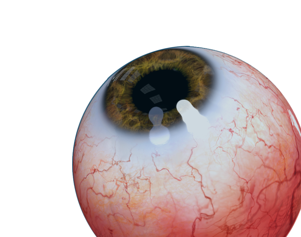 dry eye