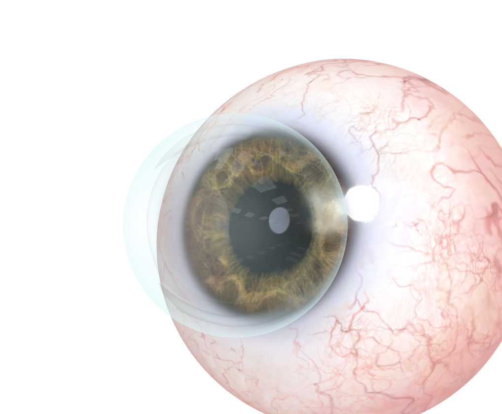 contact lens