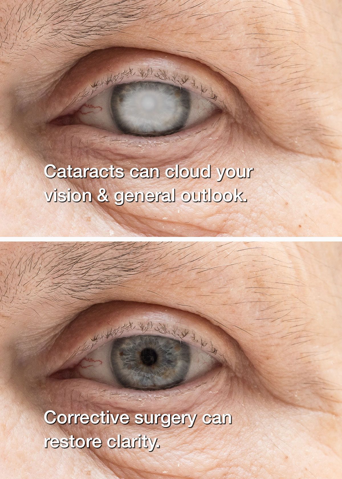 before and after cataract surgery