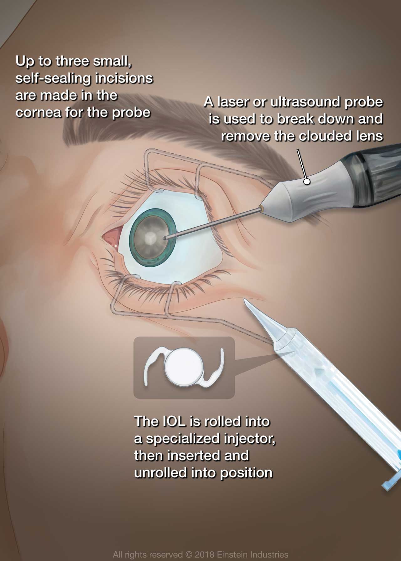Illustration of cataract surgery