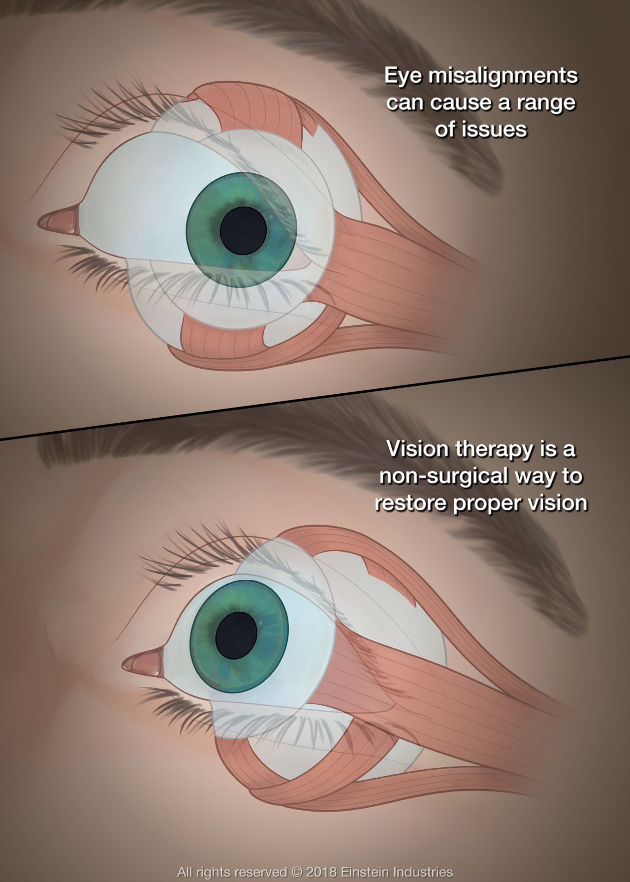 vision therapy illustration