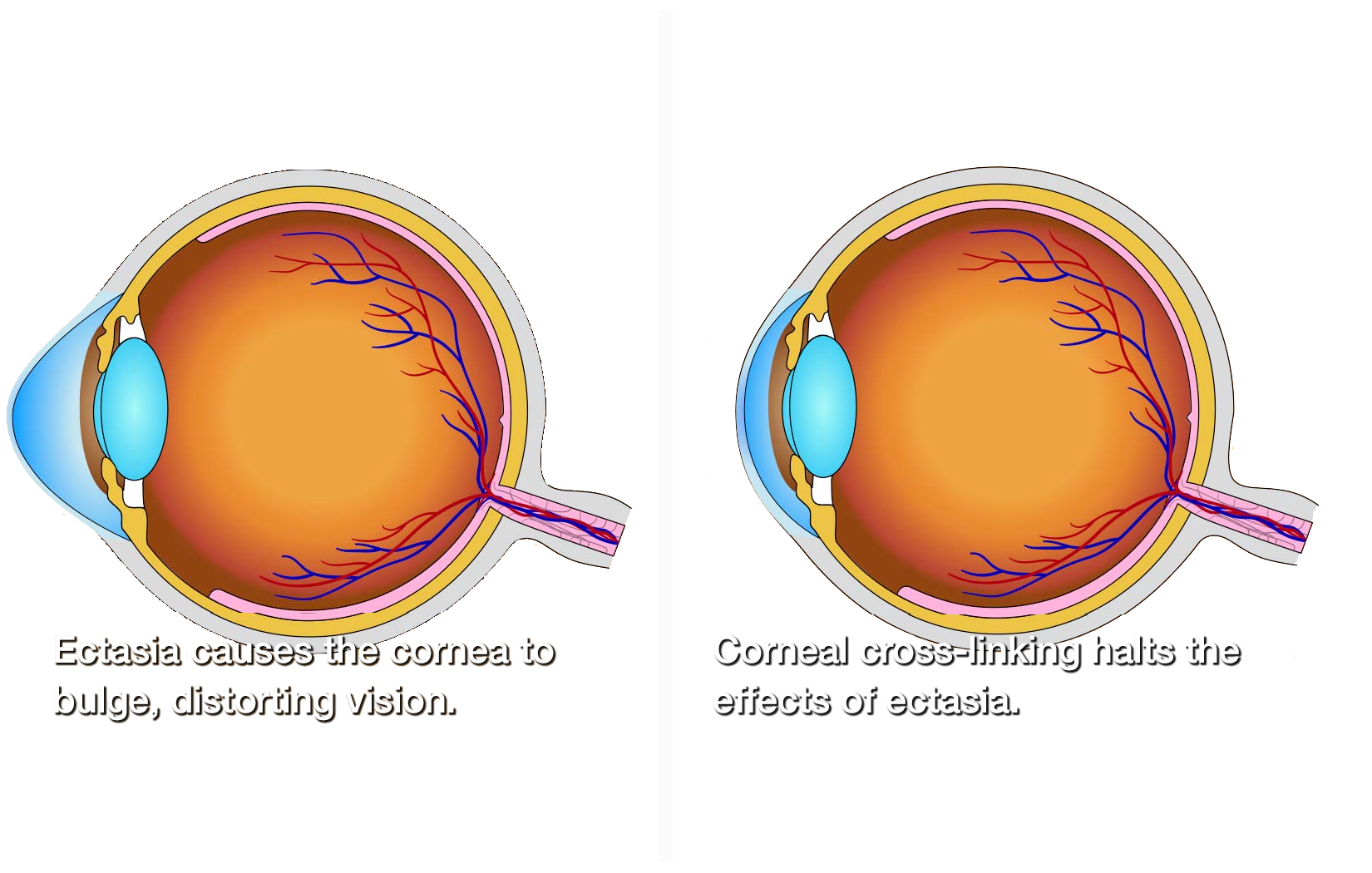 Corneal Cross Linking Corneal Cross Linking