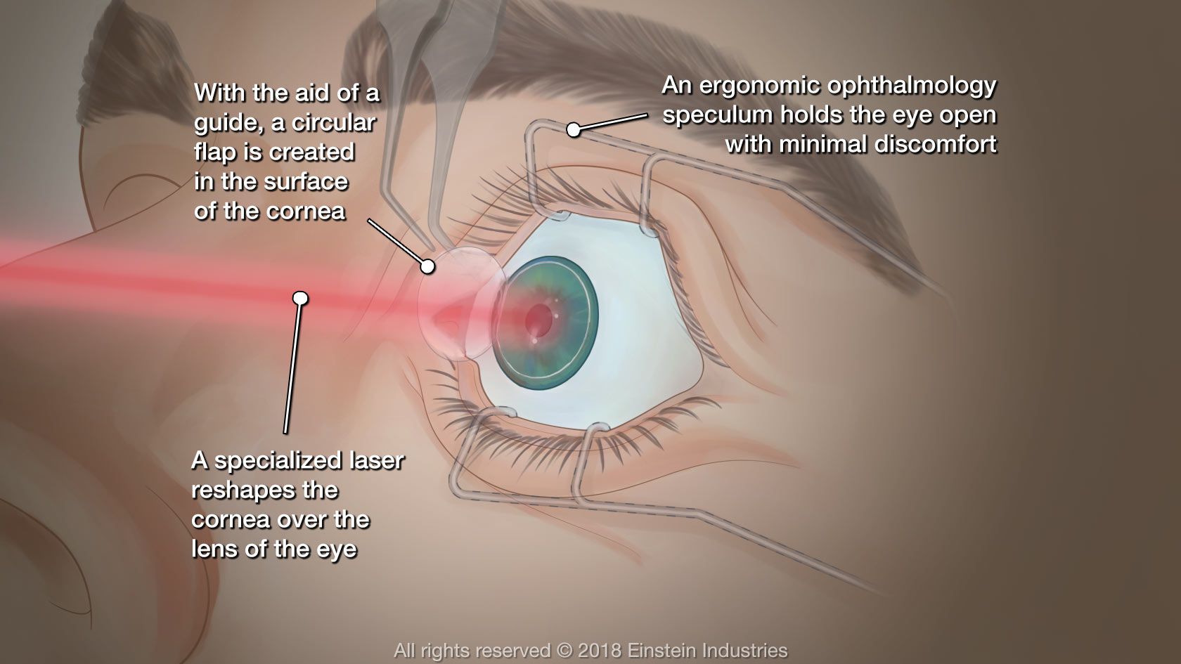 Diagram of LASIK eye surgery