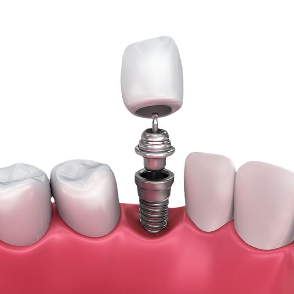Dental Implants