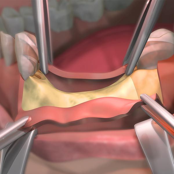 Bone Grafting