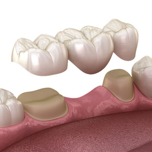 Dental bridge