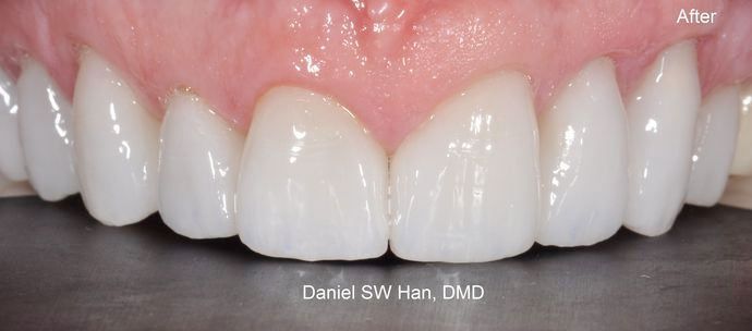 after veneers