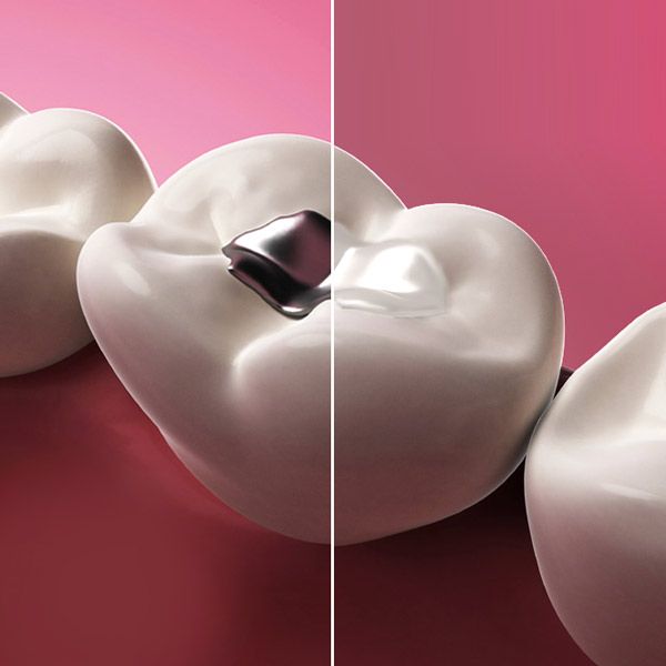 Tooth with mercury filling