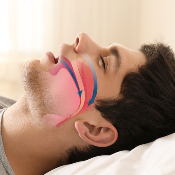 Profile view of sleeping man overlaid with illustration of closed airway