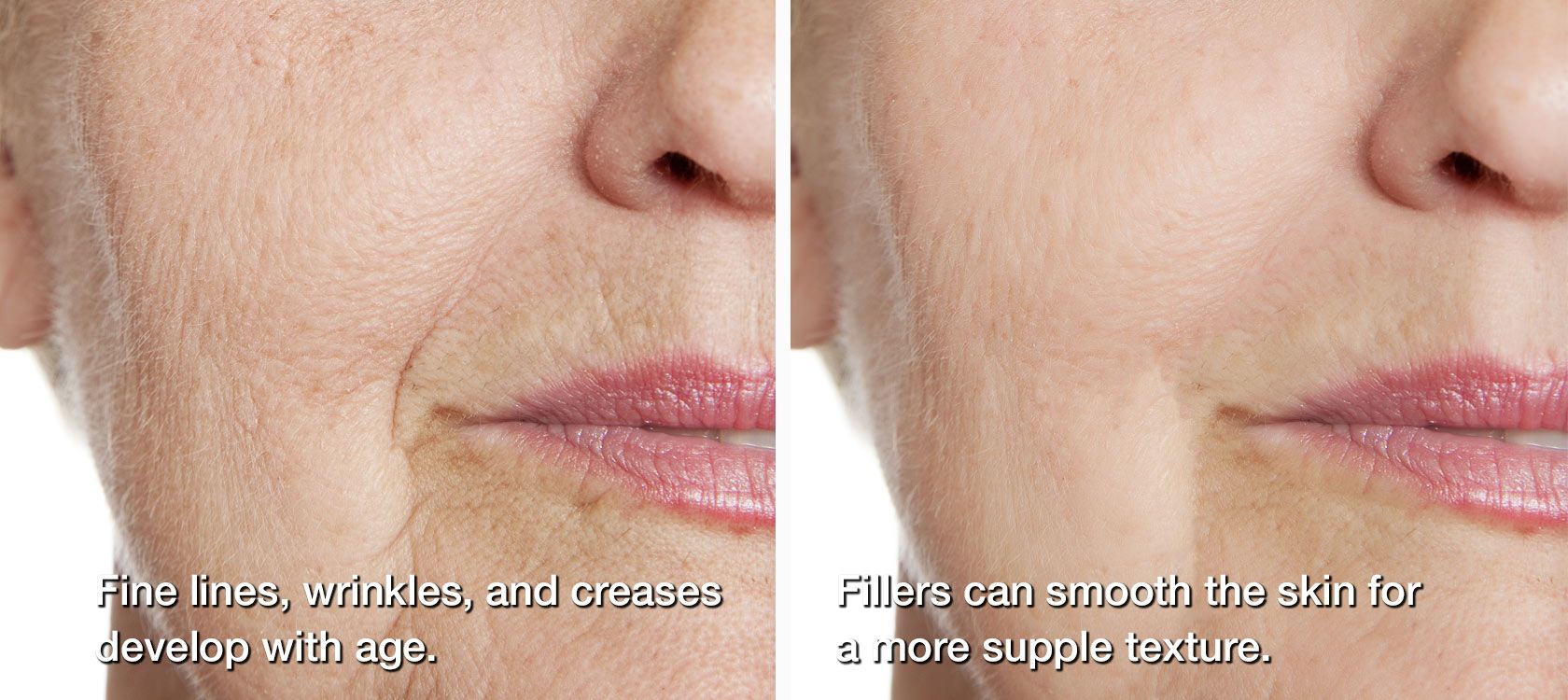 Before and after dermal fillers