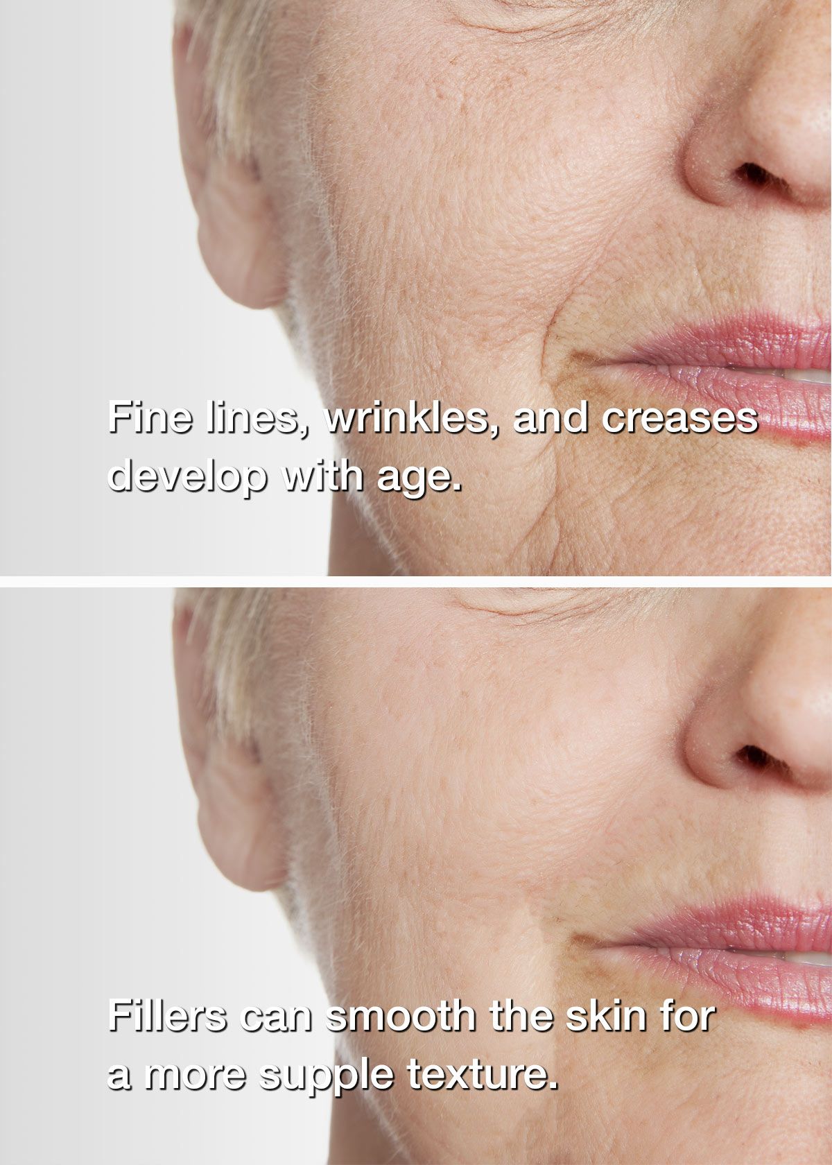Before and after dermal fillers