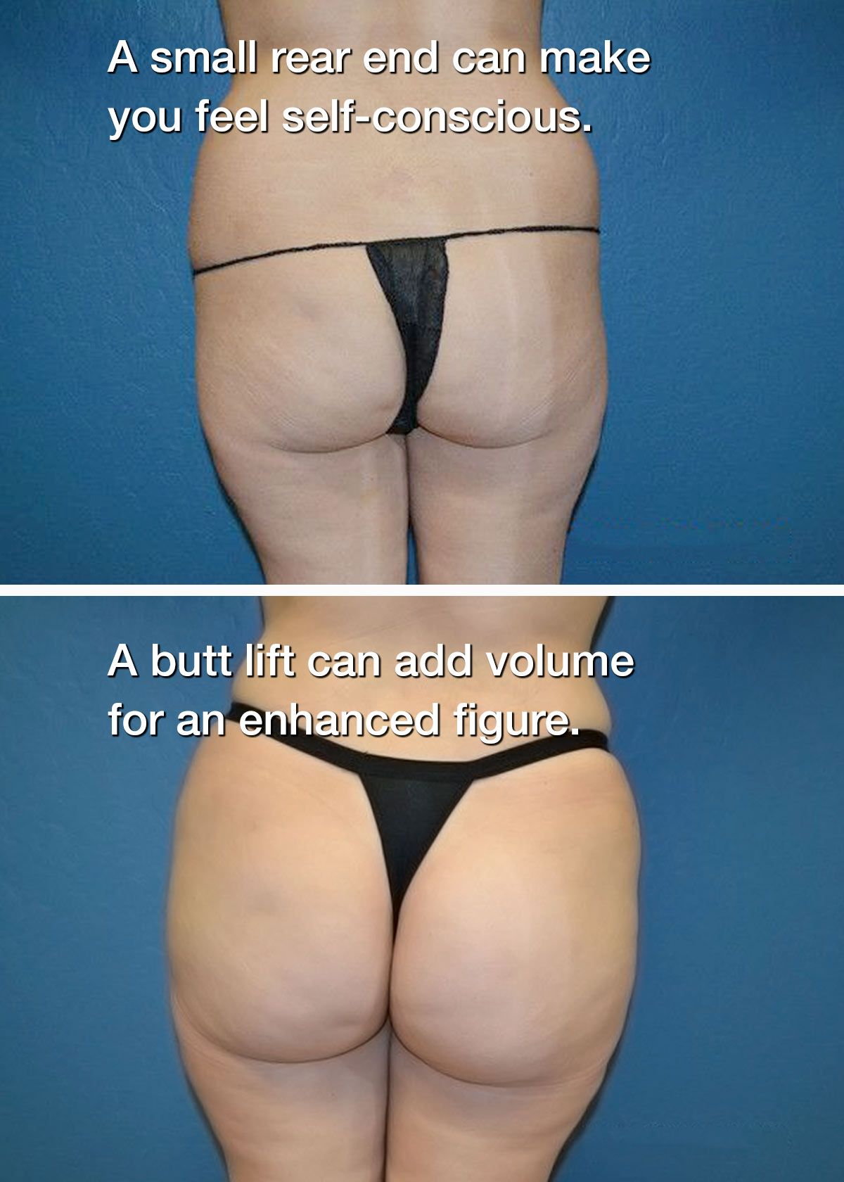 Before and after butt liftBefore and after