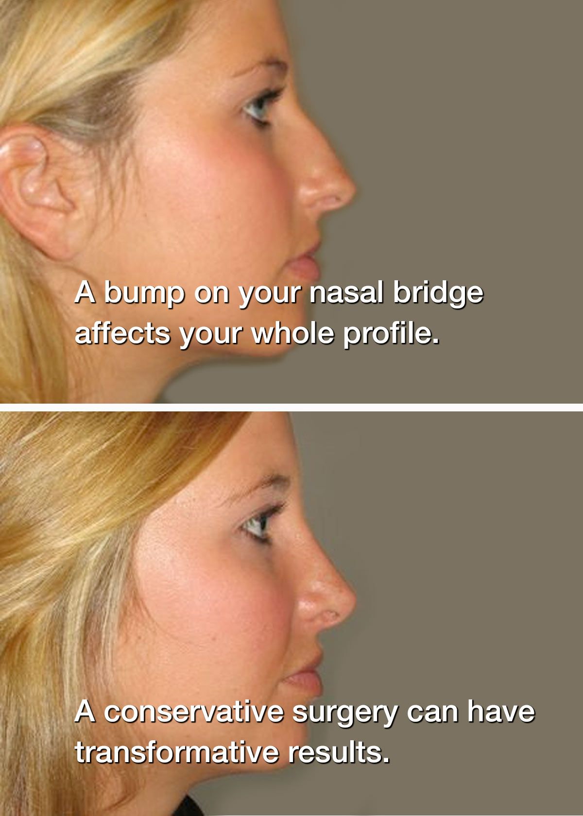 Before and after rhinoplasty