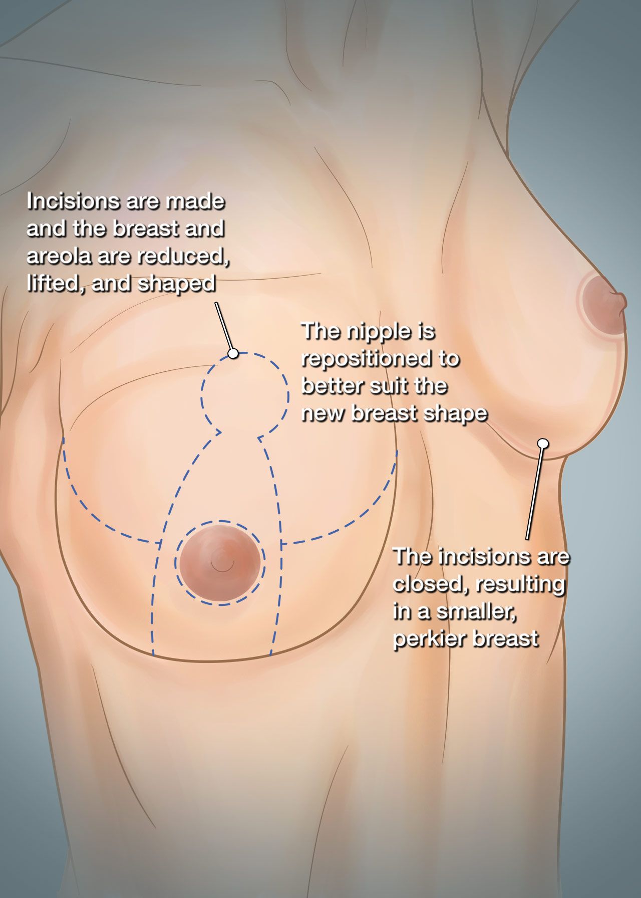 Breast reduction illustration