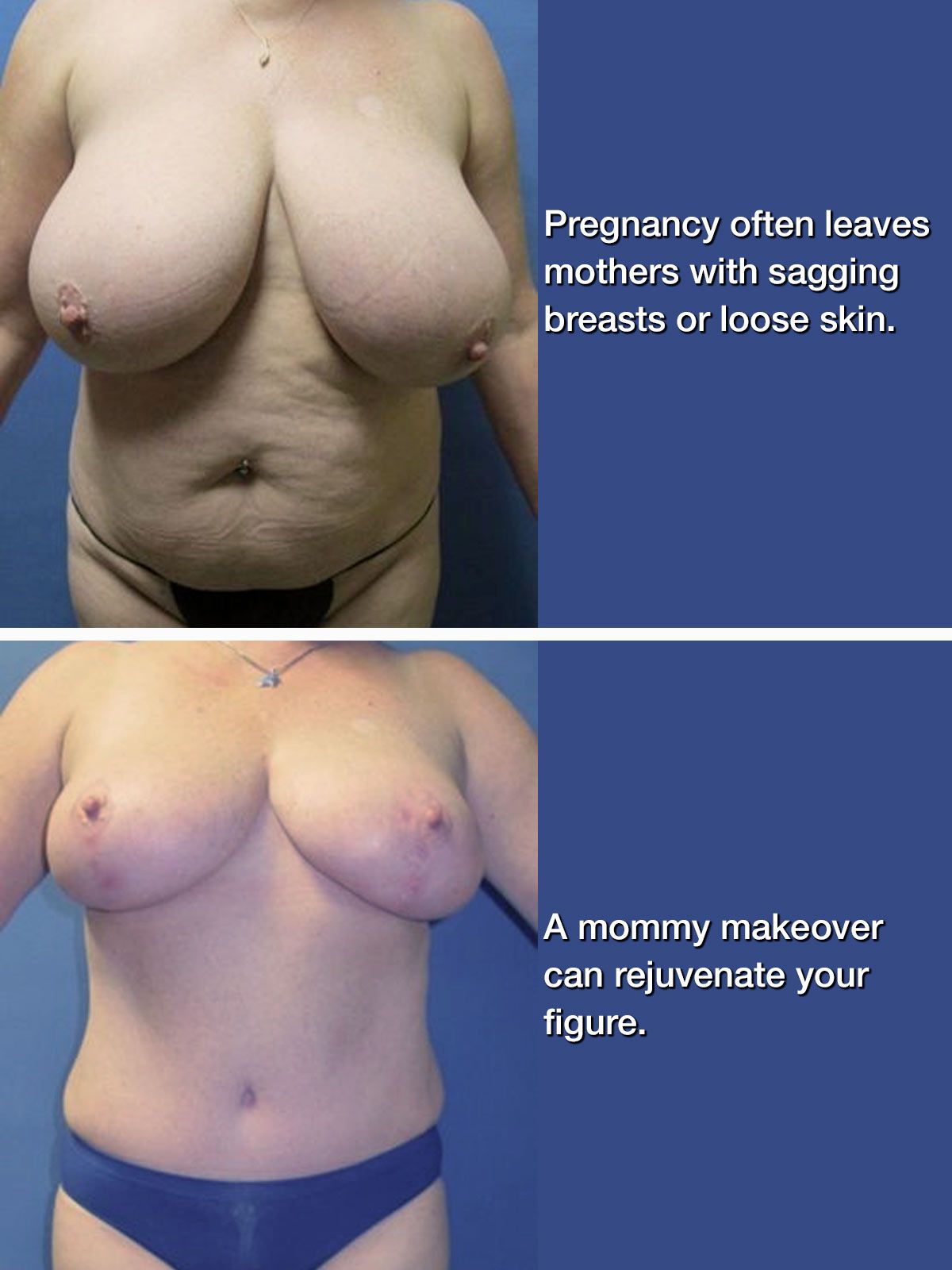 Woman's breasts before and after a mommy makeover procedure