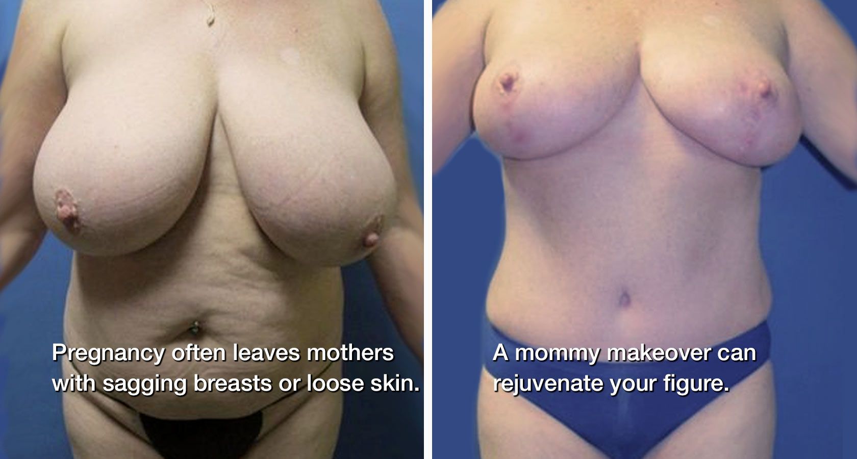 Woman's breasts before and after a mommy makeover procedure