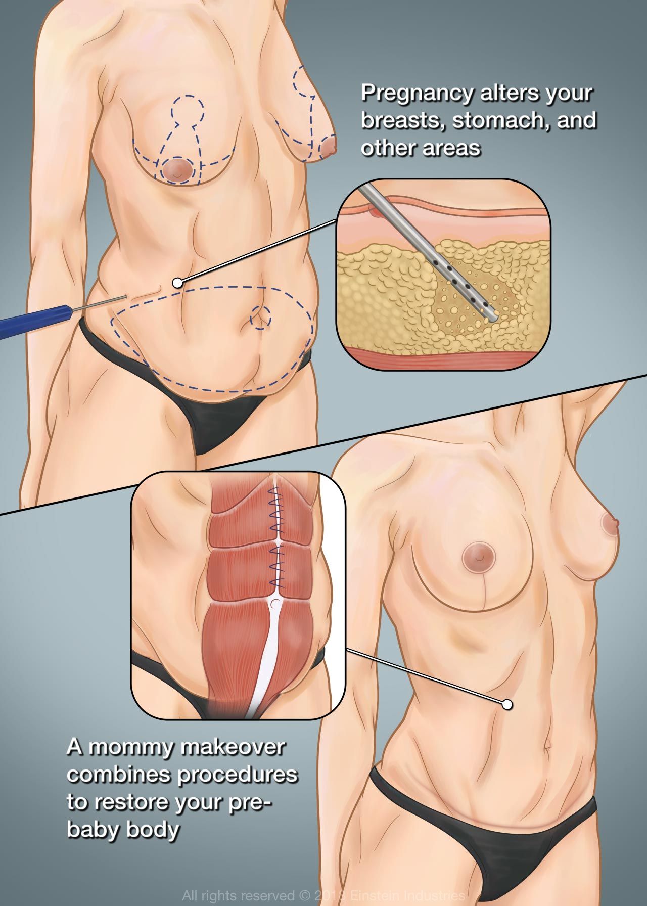 Illustration of body before and after a mommy makeover, with pull-out images of liposuction
