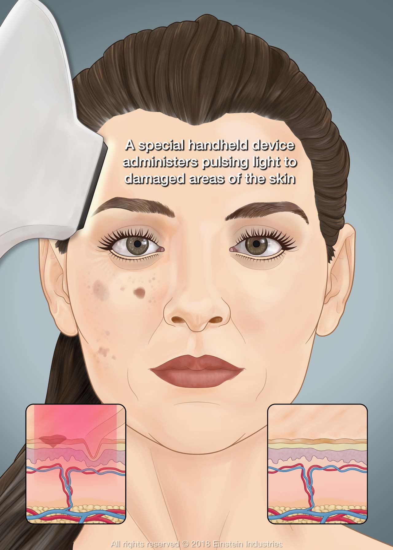 Illustration of woman with blemishes receiving IPL photofacial treatment. In background, the tissues below the skin are shown inflamed before treatment and normal afterward.