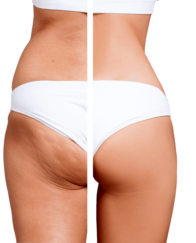 Before and after butt lift