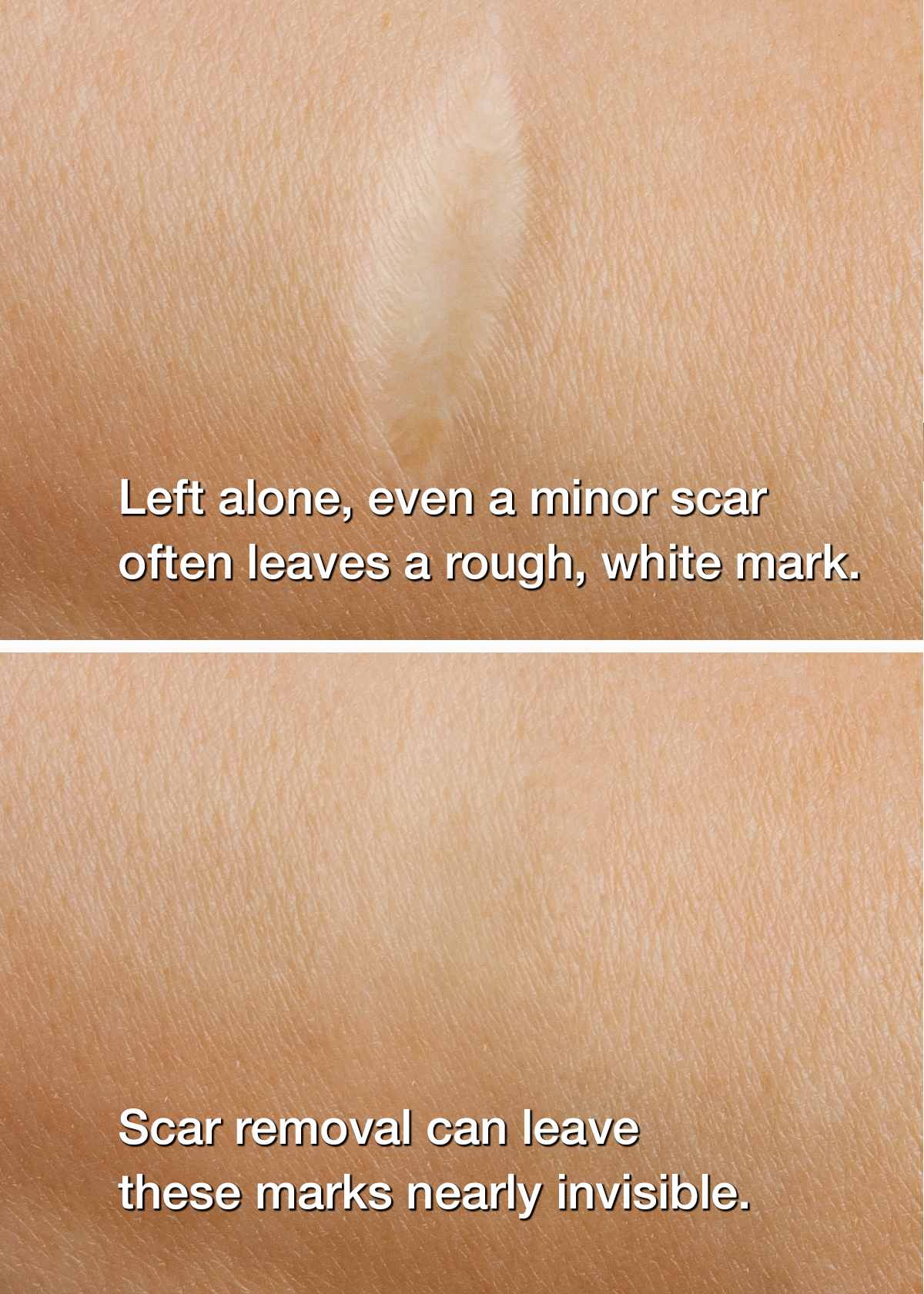 Left: Healed but visible scar. Right: Nearly invisible scar