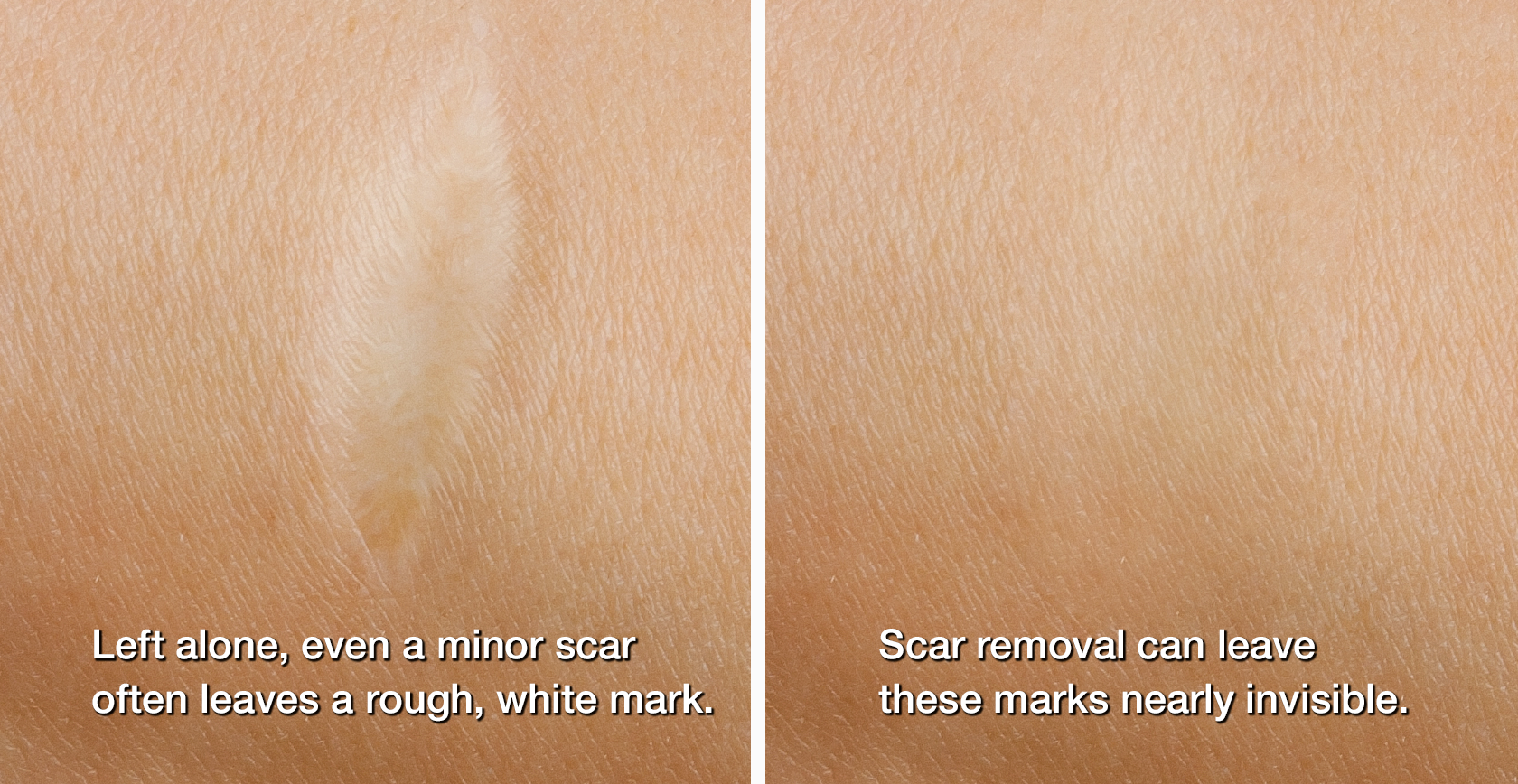 Left: Healed but visible scar. Right: Nearly invisible scar