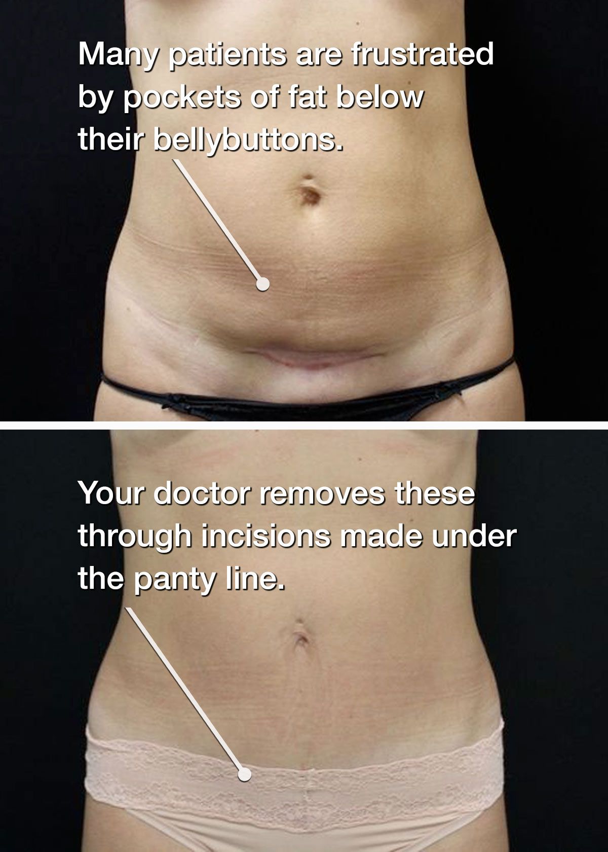 Before and after mini tummy tuck