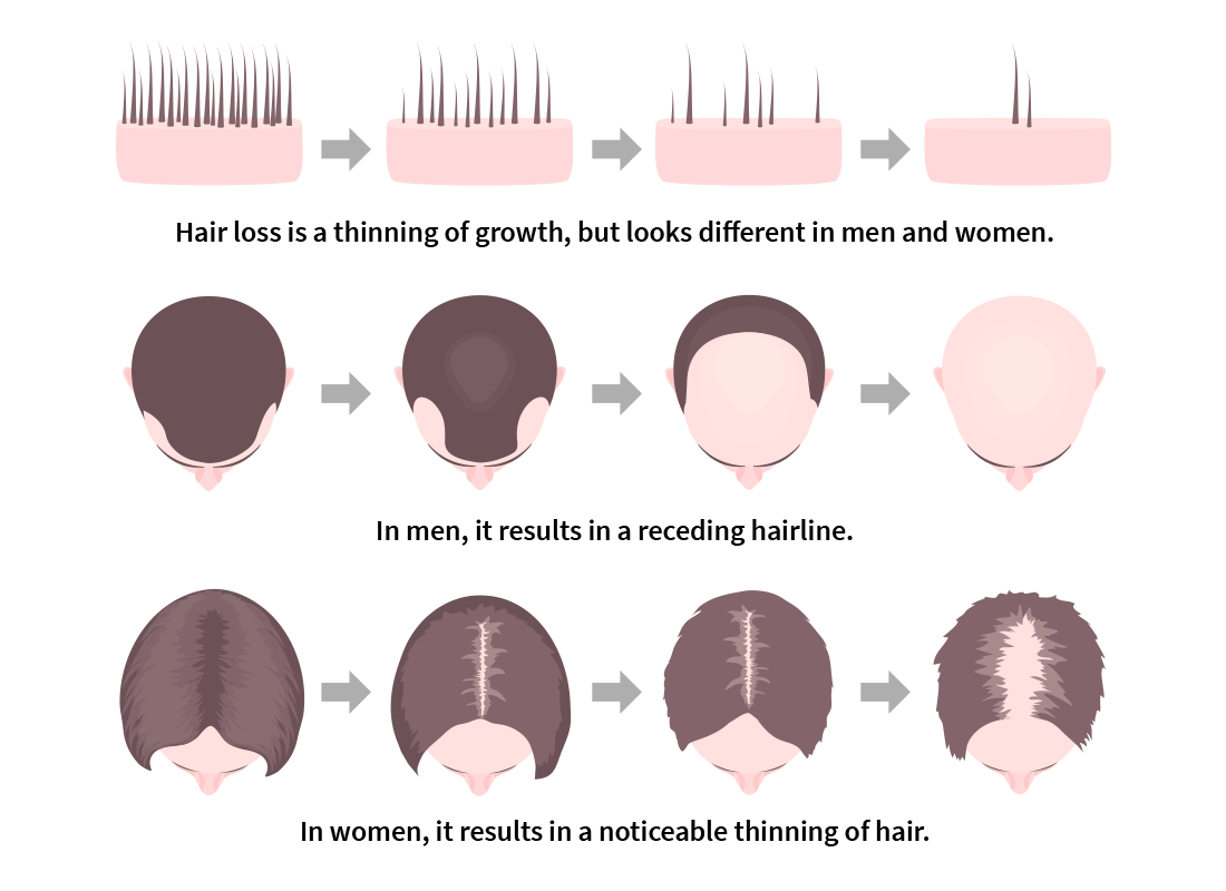 Illustration demonstrating how hair loss looks in men and women