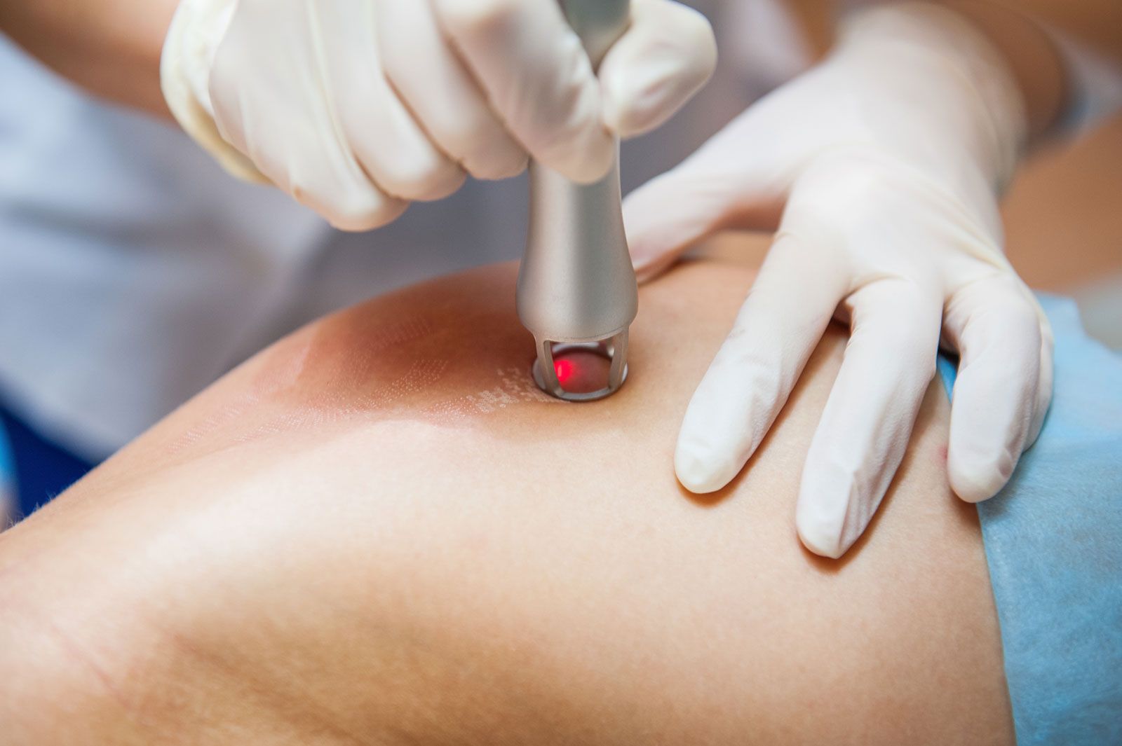 Close-up of laser scar removal
