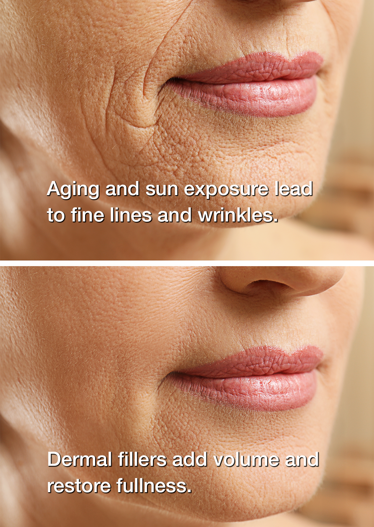 Woman's mouth before and after BOTOX injections