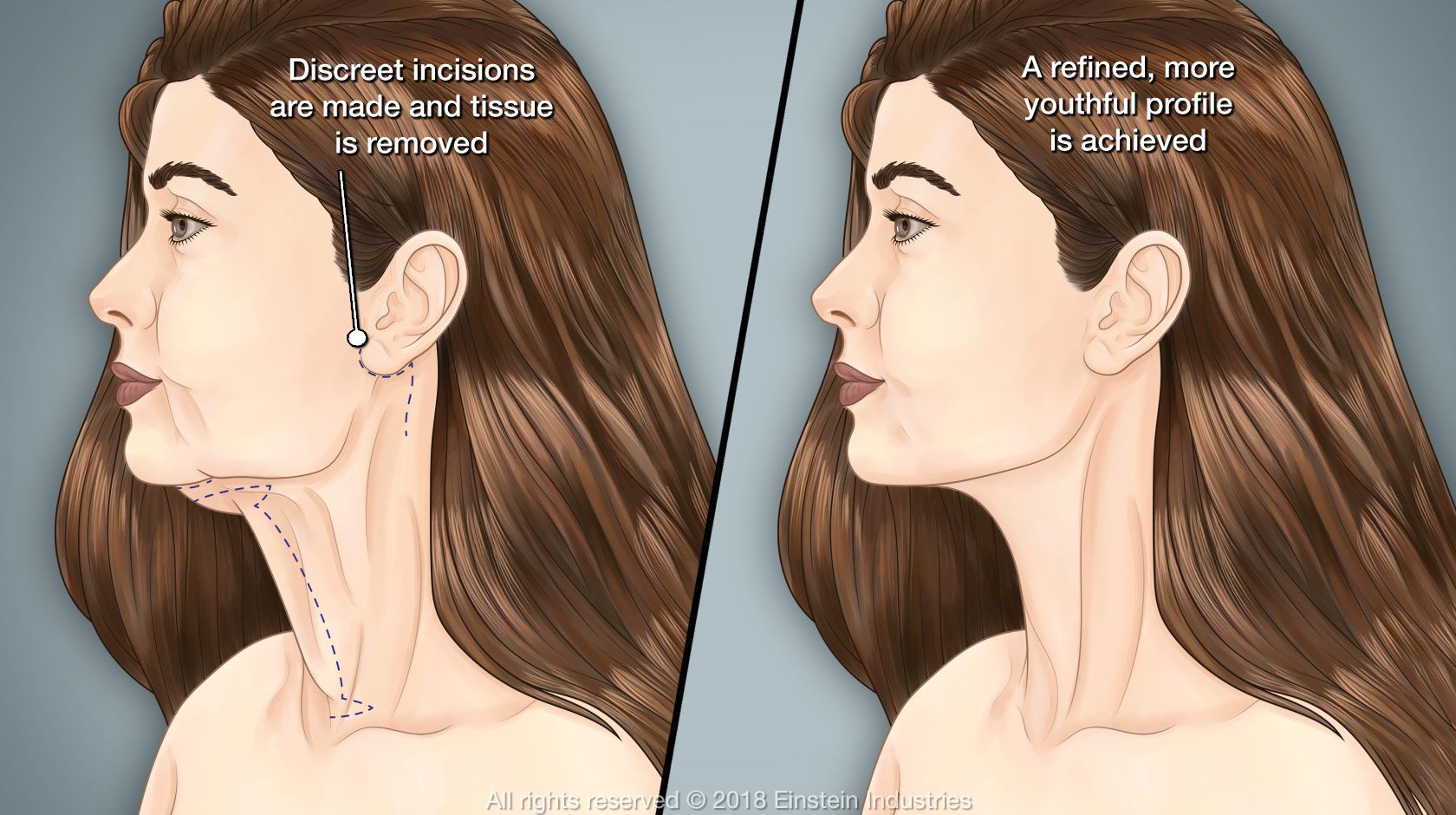 Woman before and after neck lift
