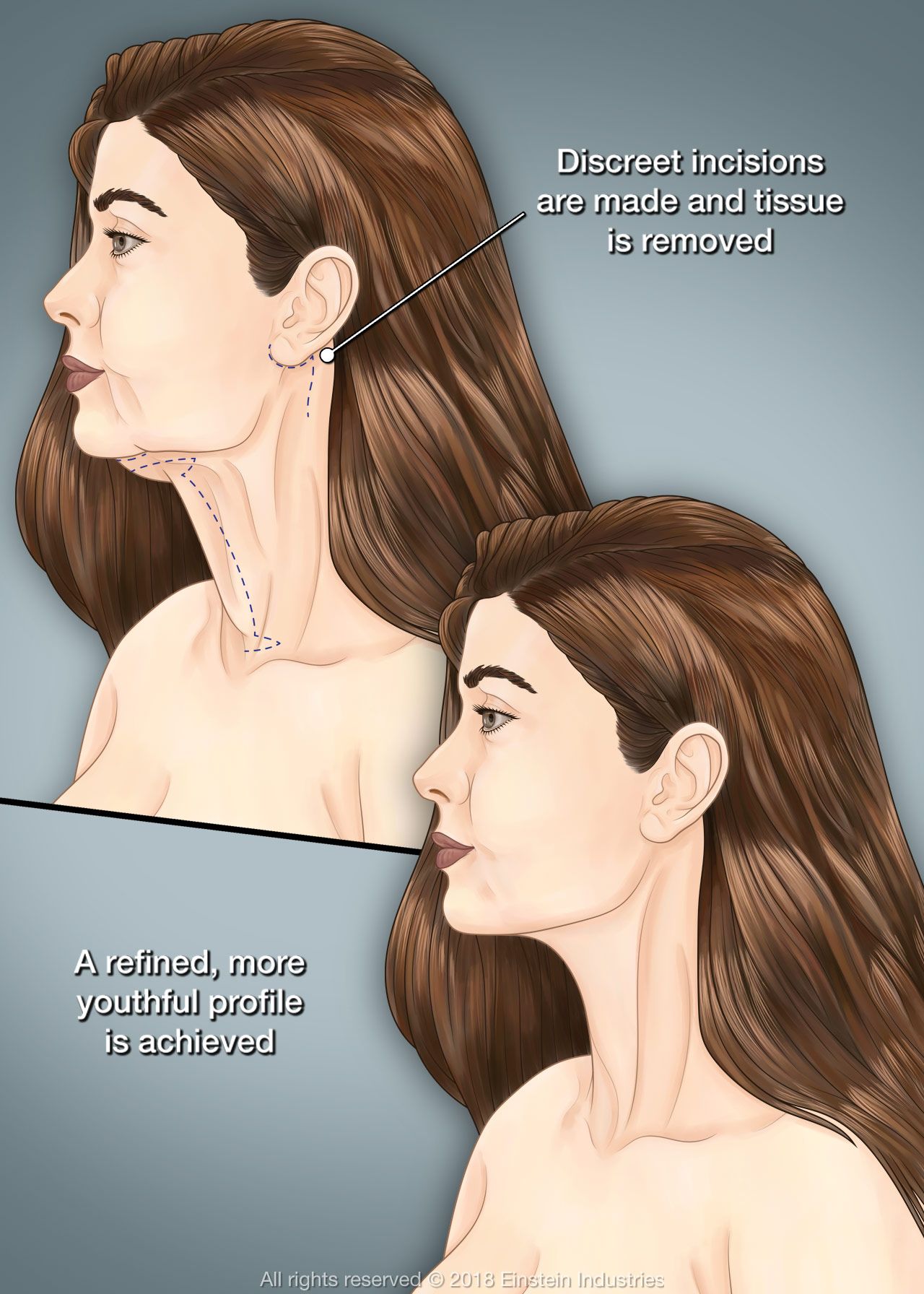 Woman before and after neck lift