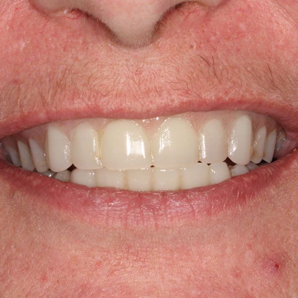 After implants