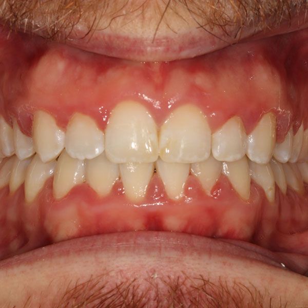 After Invisalign