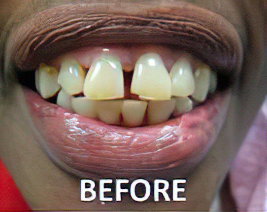 Before full mouth reconstruction