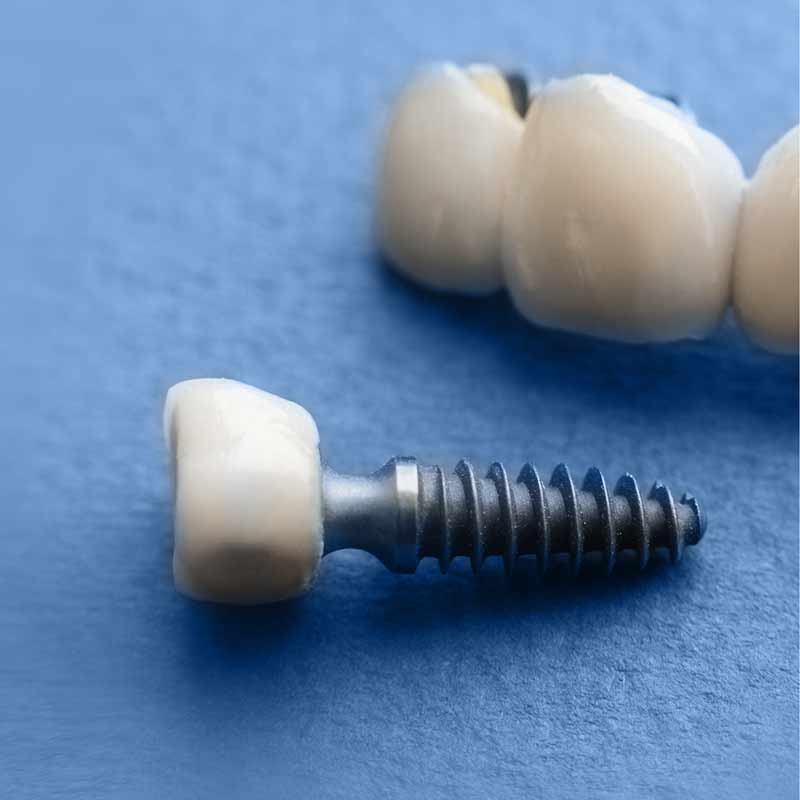 dental implants
