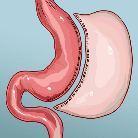 Gastric Sleeve Surgery