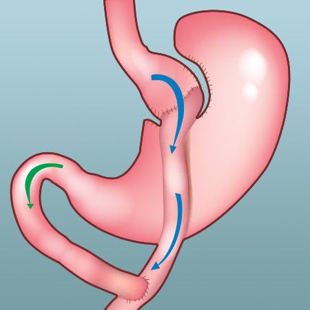 Gastric Bypass Surgery