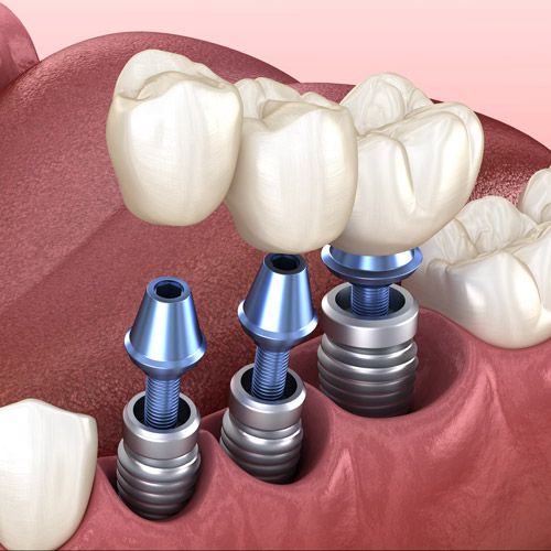 An illustration of three dental implants